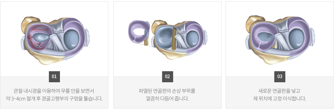 수술치료 안내 이미지 1