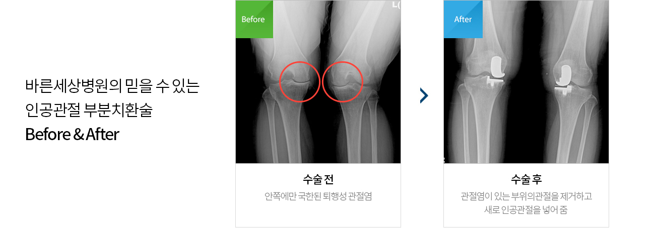 수술치료 안내 이미지 3